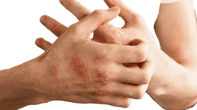 Psoriasis: symptoms, causes, types, and treatments - sharpmuscle