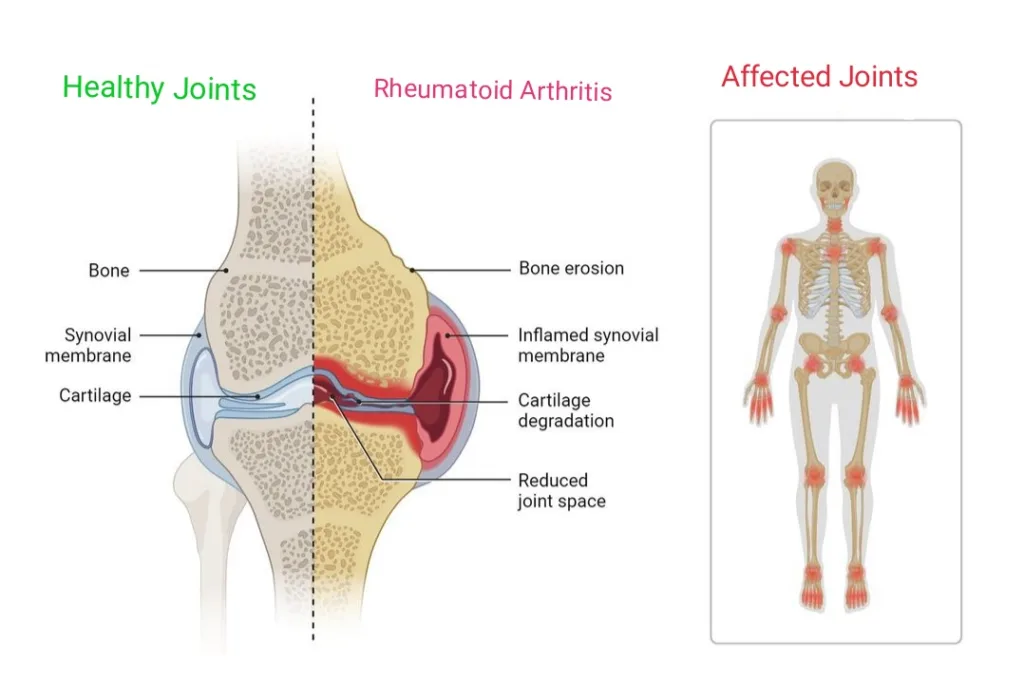 Arthritis: Causes, Treatment, and Dietary Strategies for a Healthier Life - SharpMuscle